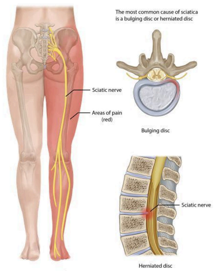 Explaining sciatic nerve